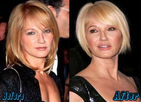 ellen barkin surgery